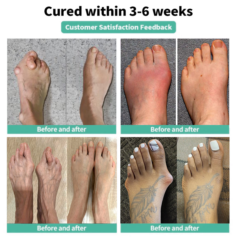 🏅Natravor® Relief Botanical Bunion Comfort Patcht👠💃（Physical Stretch Support + Botanical Comfort Formula)